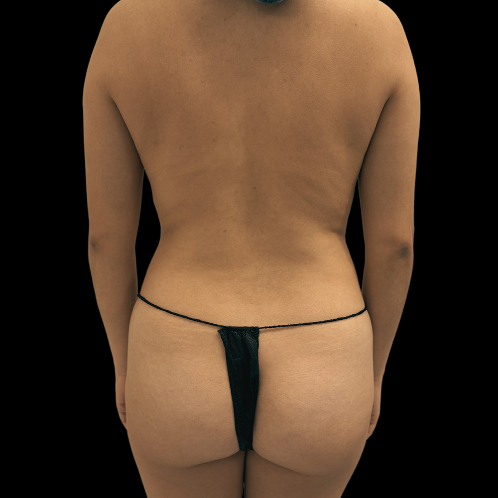 Case--8581 | After Liposuction