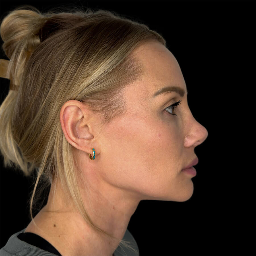 Case--1284 | After Designer Jawline