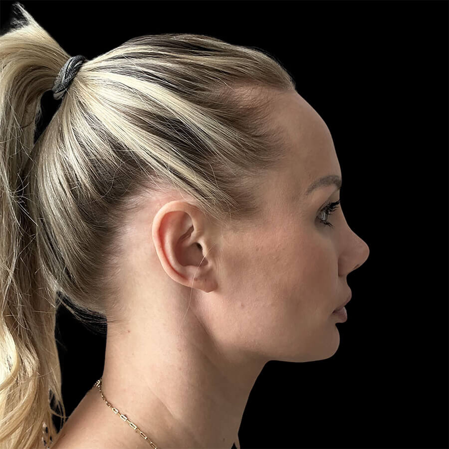 Case--1284 | Before Designer Jawline