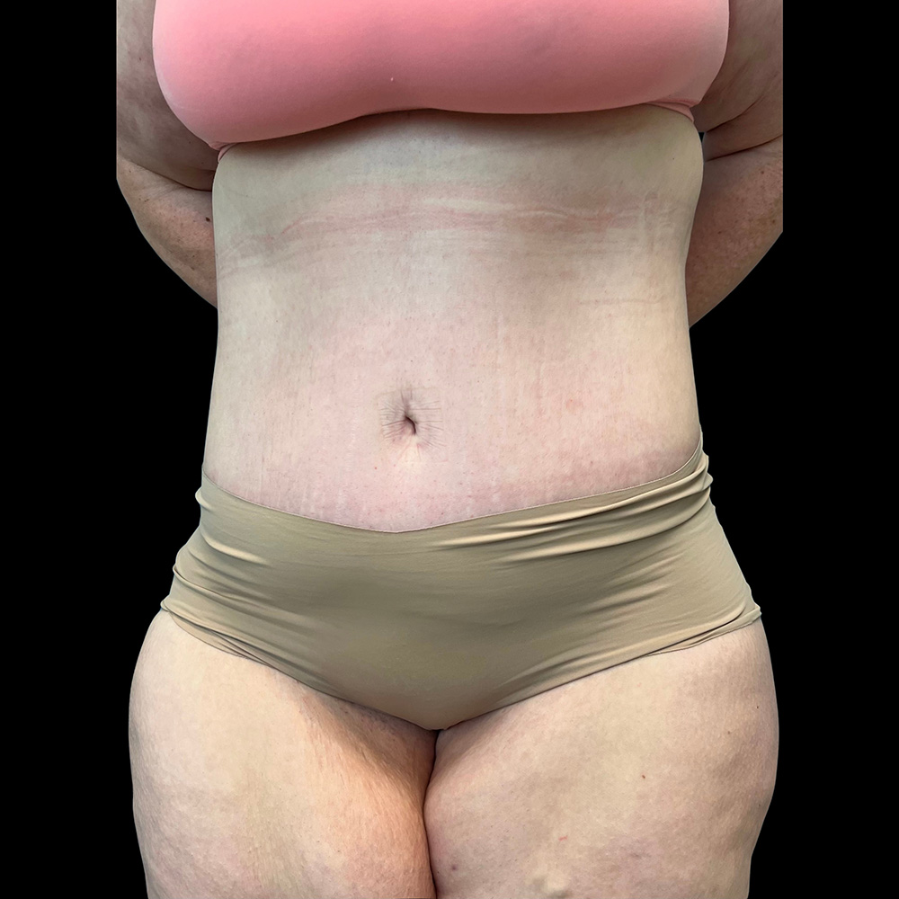 Case--6729 | After Tummy Tuck