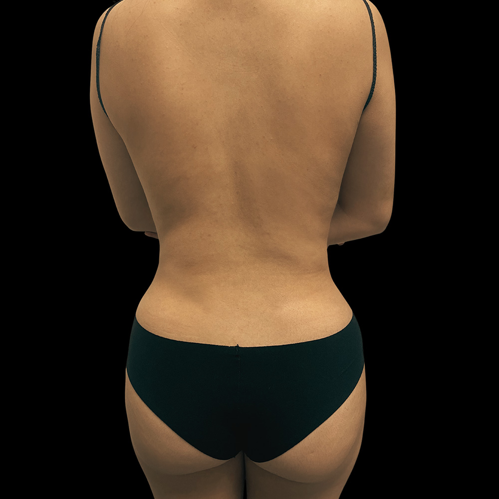 Case--8581 | Before Liposuction