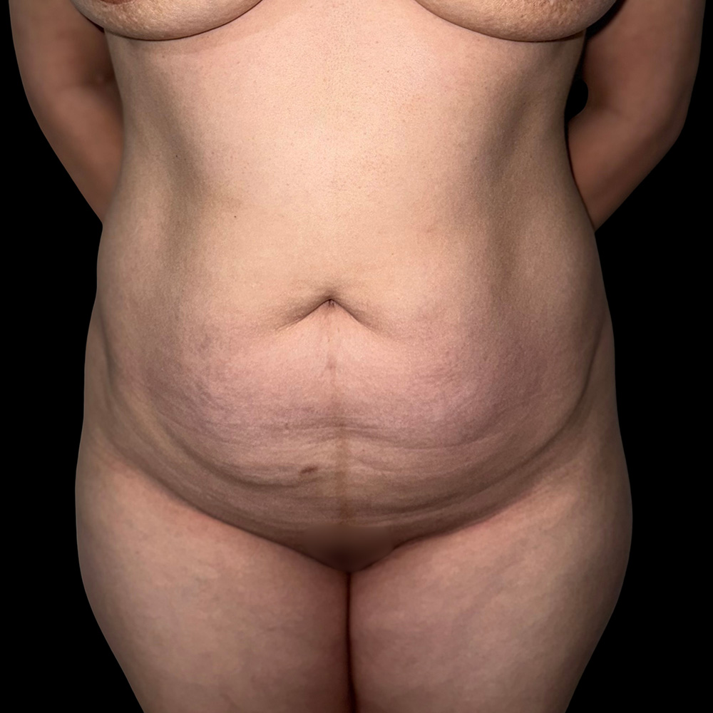 Case--3081 | Before Tummy Tuck