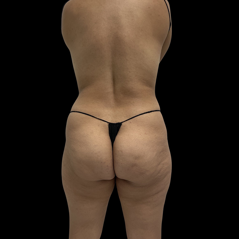 Case--5703 | Before Liposuction