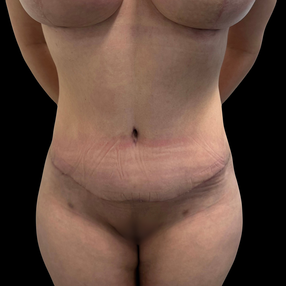 Case--3081 | After Tummy Tuck