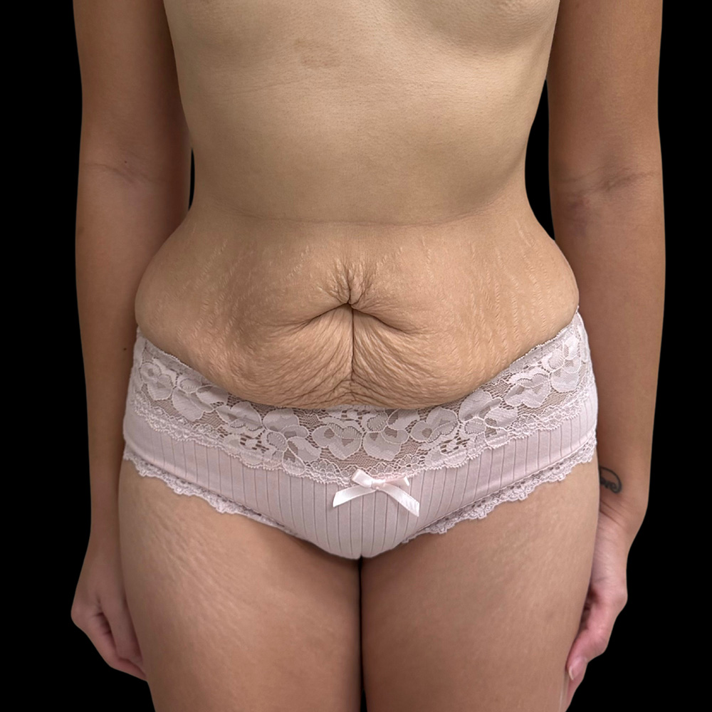 Case--4937 | Before Tummy Tuck