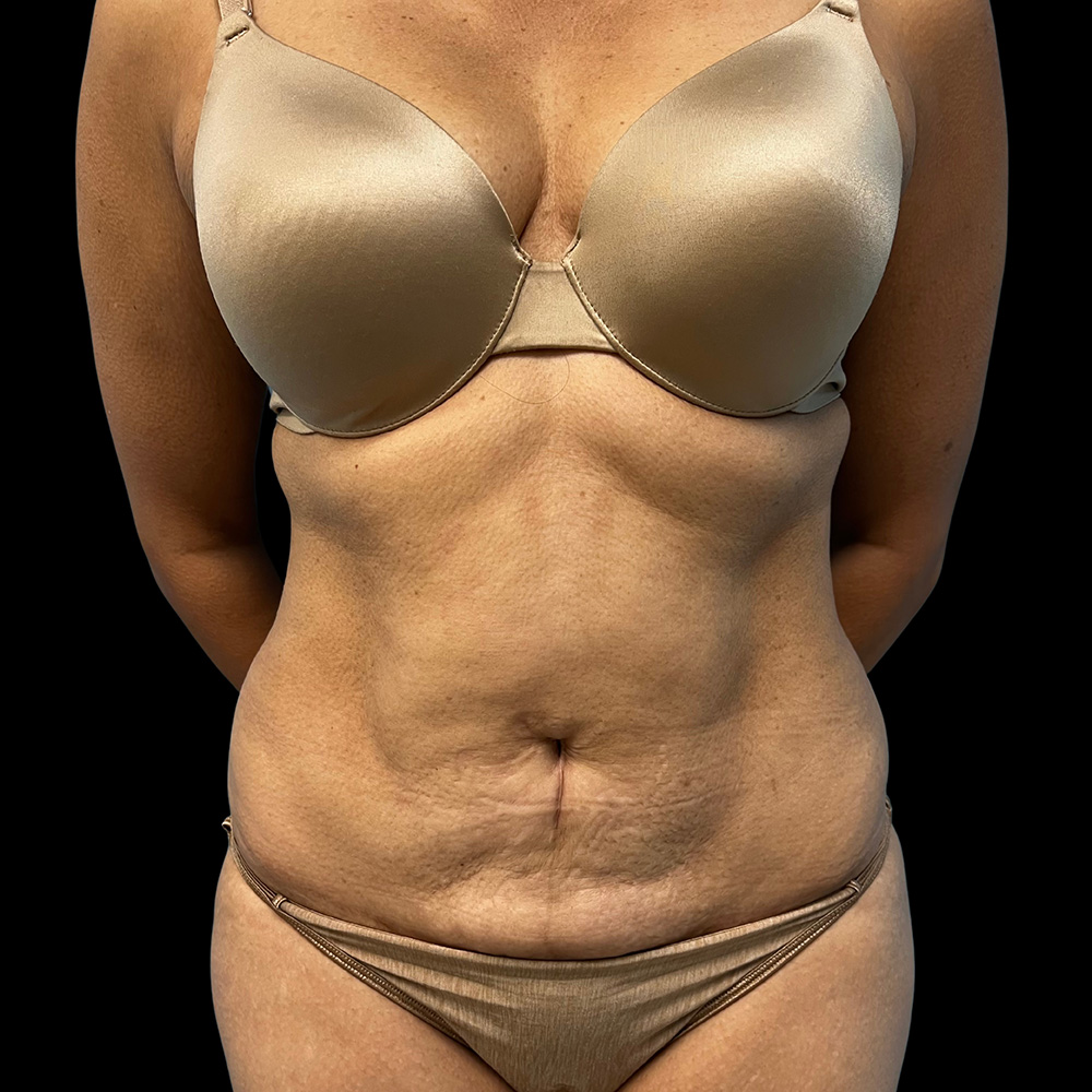 Case--4910 | Before Tummy Tuck