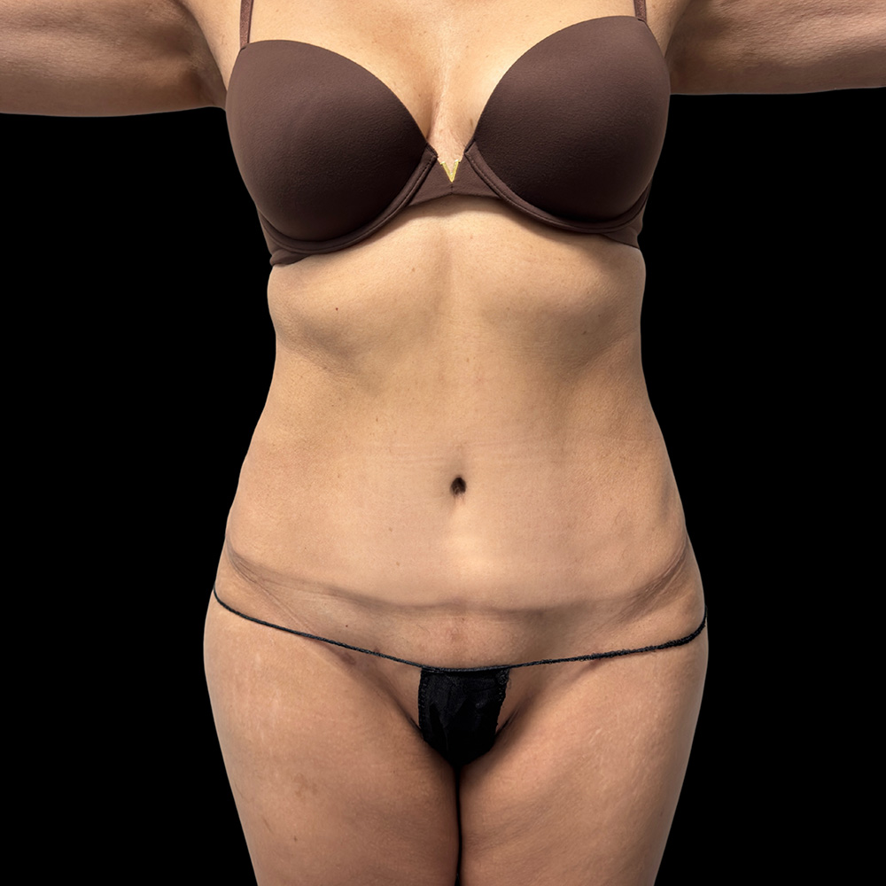 Case--4910 | After Tummy Tuck