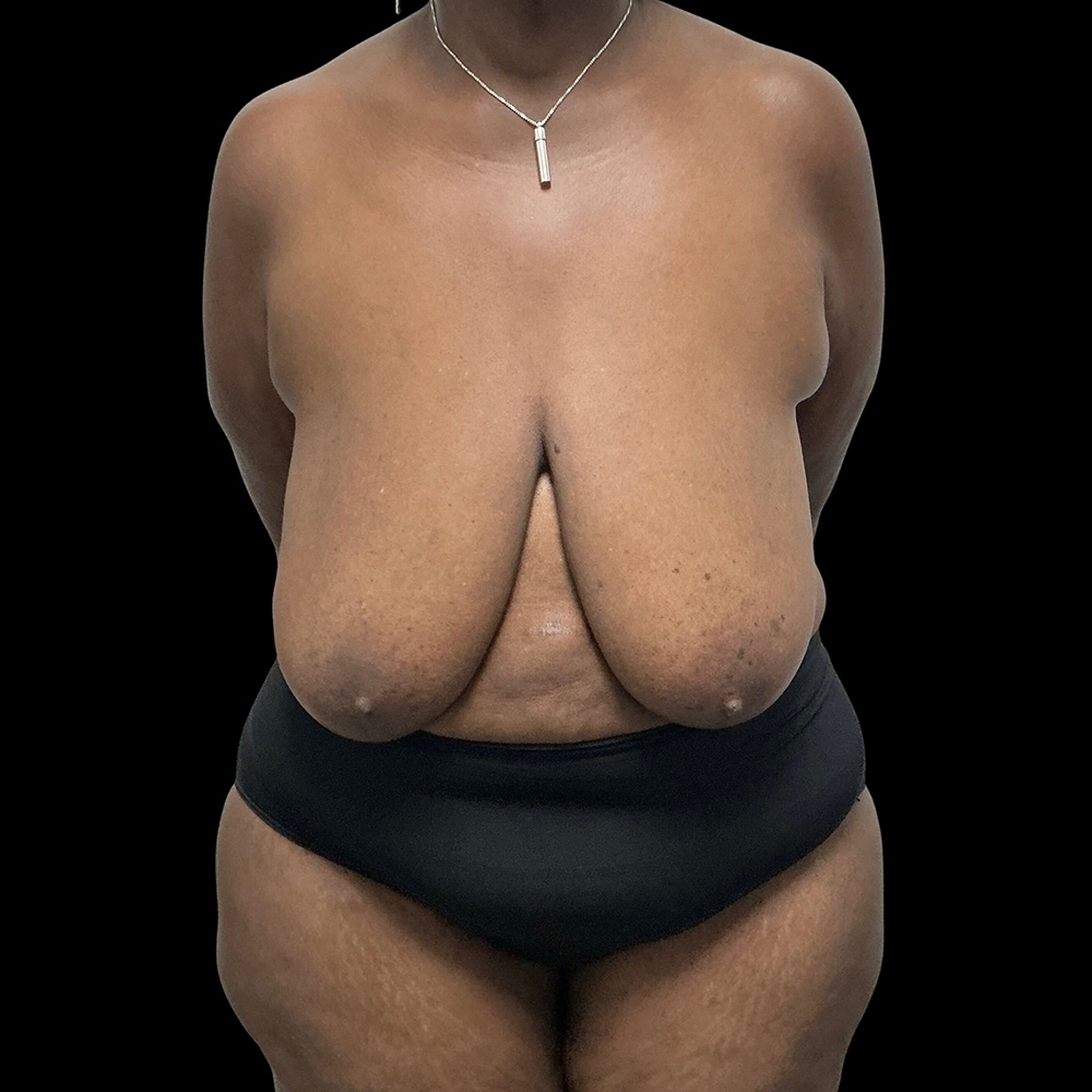 Case--2709 | Before Breast Implant with Lift