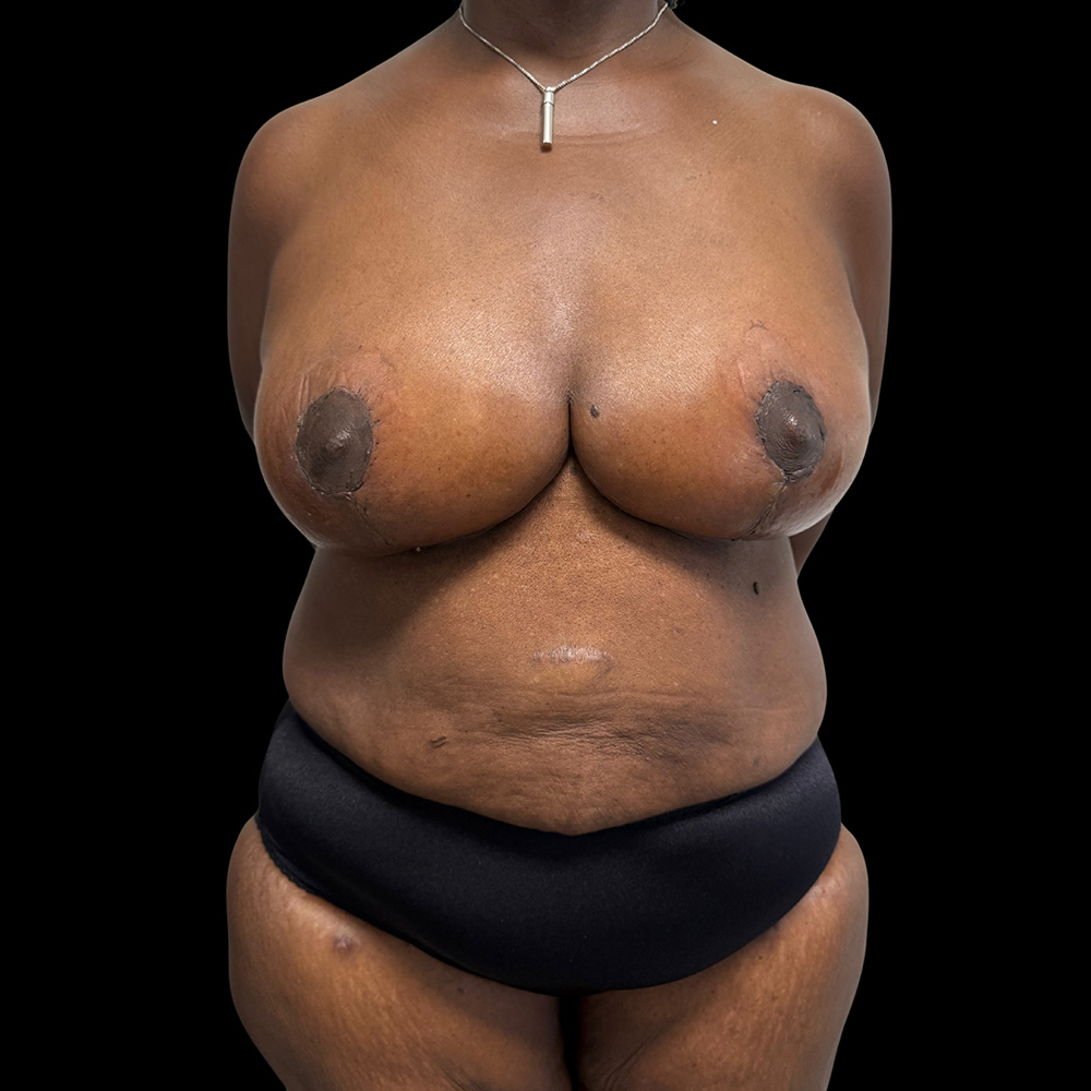 Case--2709 | After Breast Implant with Lift