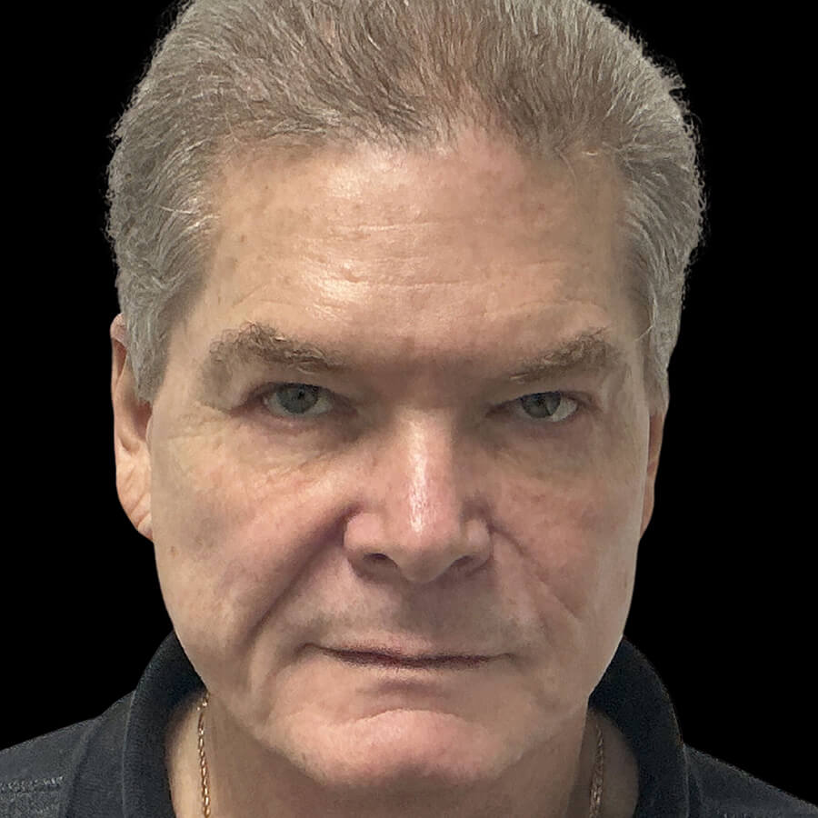 Case--8083 | After Male Facelift